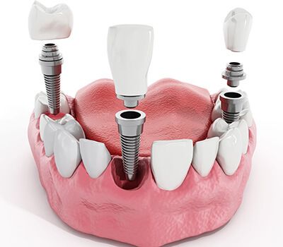 تعرفه دندانپزشکی 1402