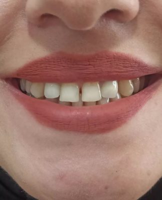 نمونه عکس قبل لمینت دندان