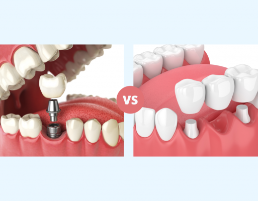 ایمپلنت دندان یا بریج (پل دندان)